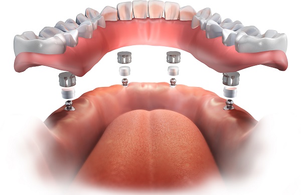 The Advantages Of Implant Supported Dentures